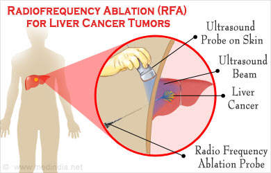 Radiofrequency Ablation RFA For Liver Cancer Tumors