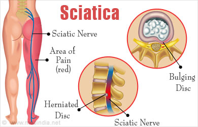 what are the causes of sciatica pressure on sciatic nerve