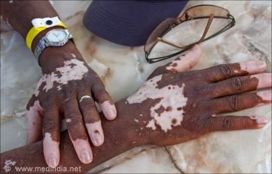 Skin pigmentation disorders: Vitiligo