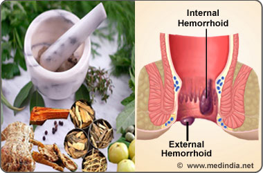 Hemorrhoids