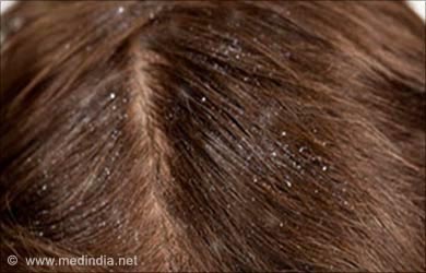 Uses of Mother Tincture: Dandruff