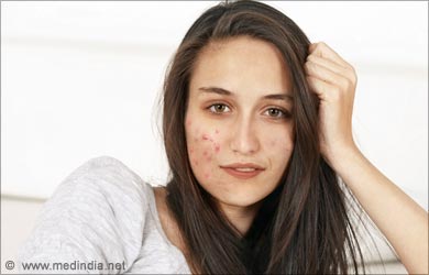 Uses of Mother Tincture: Acne
