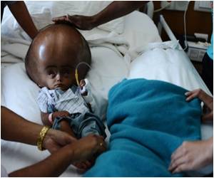 Baby's Swollen Head Reconstructed by Indian Surgeons