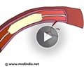 Angioplasty - Excimer Laser