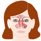 Sinusitis