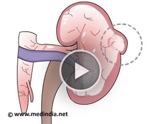 Open Partial Nephrectomy