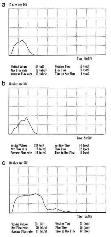 Normal Uroflowmetry