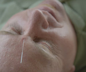  Acupuncture and Acupressure Treatment  - All About  Needles and Needless Pain