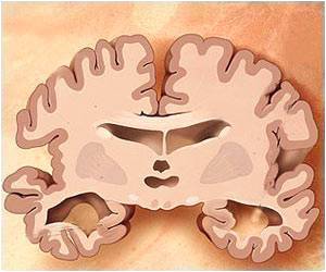 Mastinib as Add-on Treatment Improves Patients With Alzheimers Disease