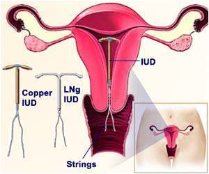  Early Versus Delayed Use of IUD Post First Trimester Abortion  Which is Better?
