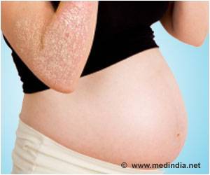 Effect of Psoriasis and Its Treatment on Pregnancy