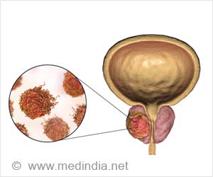 New Gene HSD17B4 may help Ward Off Prostate Cancer