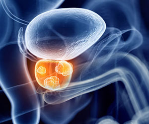  Early Use of Abiraterone in Hormone-Sensitive Advanced Prostate Cancer Recommended