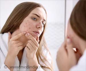 Acne Awareness Month: Journey to Clear Skin