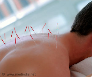 Acupuncture for Back Pain
