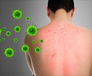 Allergic Reactions Among Psoriatic Patients