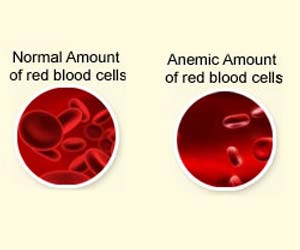 New Portable Blood Analyzer Improves Anemia Detection