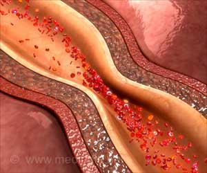 Addressing Key Immune Reaction May Reverse Arterial Disease