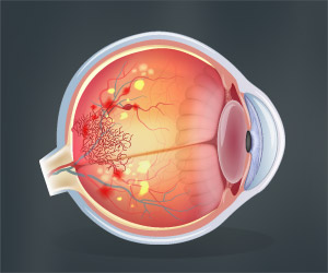 Red Color Channel Better Suited to Detect Diabetic Eye