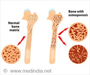 Could Poor Sleep Be Leading to Bone Loss?