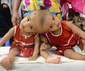 Dhaka Twins Conjoined at Head now Separate and Stable