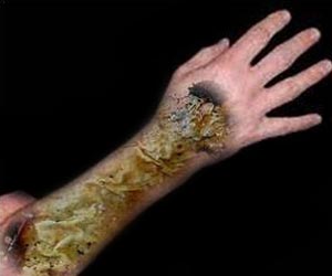 Multi-layer Living Bandages to Heal Burn Injury Without Pain
