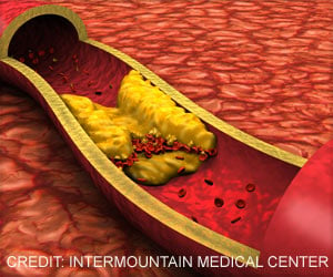 Beyond Cholesterol: The Hidden Lipids Behind Trans Fat-Induced Heart Disease