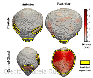 Shape of Prostate Could Be an Indicator of Cancer