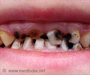 Prescription Drugs, Celecoxib, and Indomethacin can Cause Abnormal Development of Teeth in Children