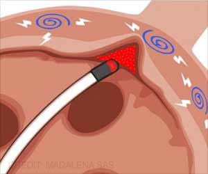 A New Twist on Atrial Fibrillation Treatment