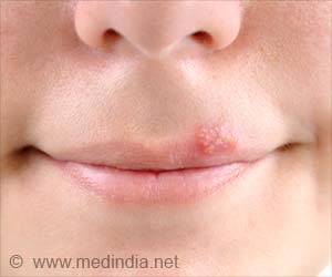  How to Relieve and Prevent Cold Sores?