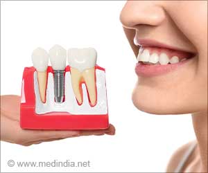 Dental Implants Will Make You Smile Soon With New Frame