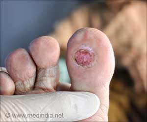 Skin Manifestations of Diabetes You Shouldn't Ignore