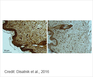 Huntington's Disease : Novel Blood Test Predicts Risk Of Onset And ...