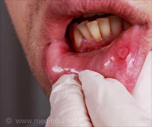 Oral Cancer Treatment Side Effect Prevented by New Drug