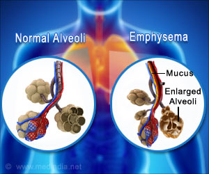 New Insights into Emphysema Progression After Treatment