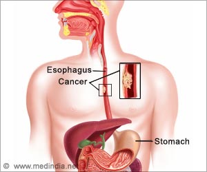 esophagus cancer