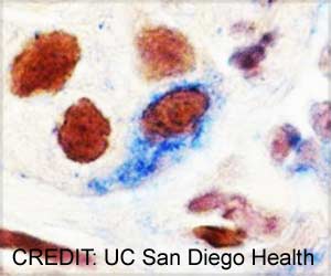 New Therapeutic Approach May Stop Breast Cancer Metastasis And Recurrence