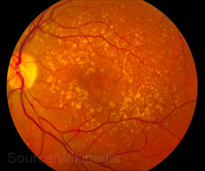 CRISPR-Cas9 System to Treat Age Related Macular Degeneration