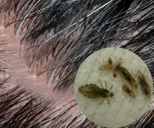 Head Lice Causes Symptoms  Treatment  Bupa UK