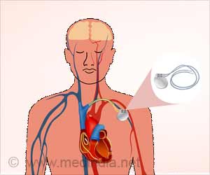 Wearable Heart Monitors to Detect Early Atrial Fibrillation