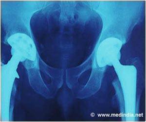 New Drug-Eluting Method To Reduce Joint Implant Infection