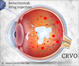Low Cost Bevacizumab as Effective as Aflibercept Drug for Central Retinal Vein Occlusion