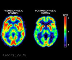 Alzheimers Risk in Menopausal Women