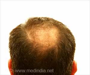Immunosuppressants Side Effect May Benefit People With Hair Loss