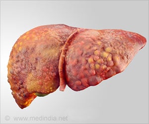 New Hope for Treating Non-Alcoholic Fatty Liver Disease