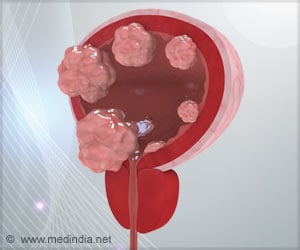 Common Cold Virus can Potentially Treat Bladder Cancer