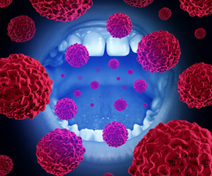 Revealing Drug Resistance Mechanisms in Tongue Cancer Using Organoids