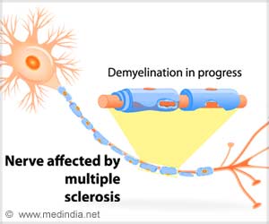 Ozanimod Shows Positive Response in Relapsing Multiple Sclerosis in Two ...