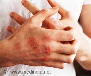 Fight Eczema and Staph Infections With Berberine